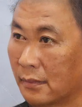 去眼袋手术