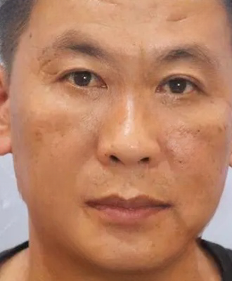 去眼袋手术