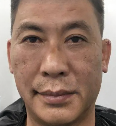 去眼袋手术