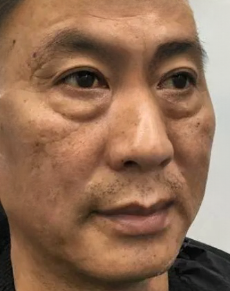去眼袋手术