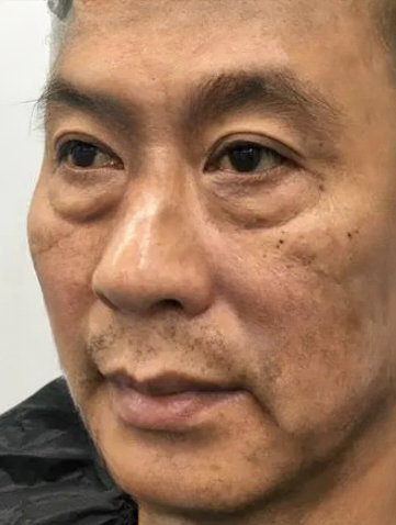 去眼袋手术