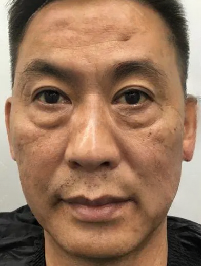 去眼袋手术