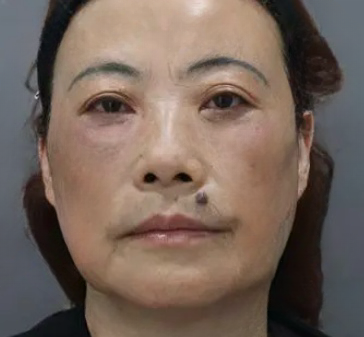 去眼袋手术