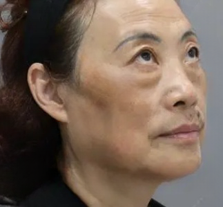 去眼袋手术