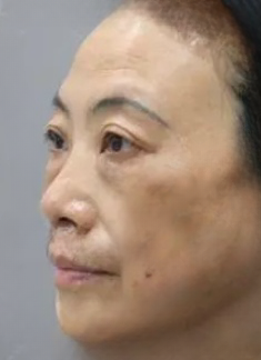 去眼袋手术