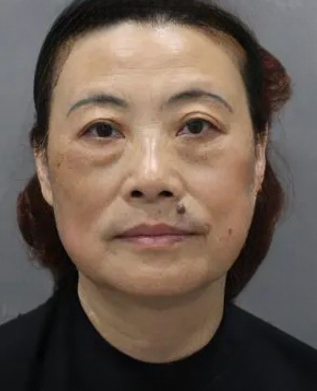 去眼袋手术