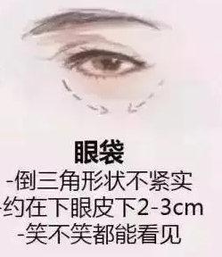 去眼袋手术