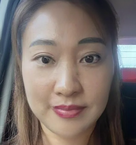 去眼袋手术