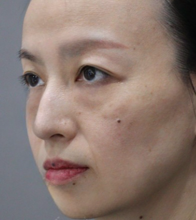去眼袋手术