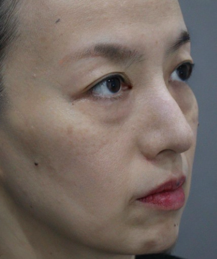 去眼袋手术