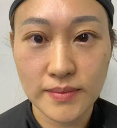 去眼袋手术
