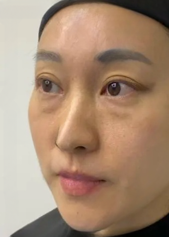 去眼袋手术