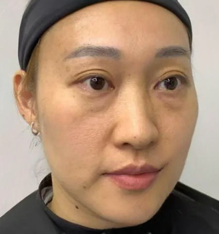 去眼袋手术