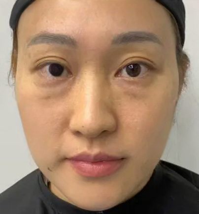 去眼袋手术
