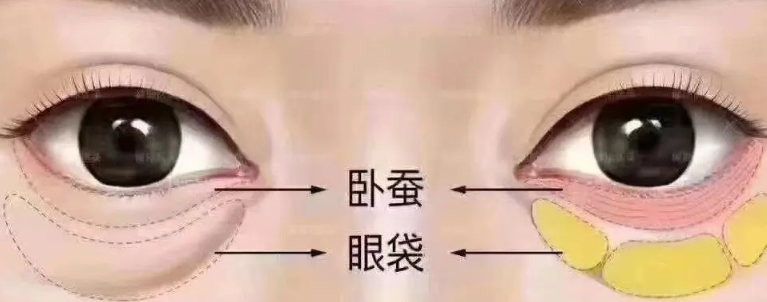 去眼袋手术