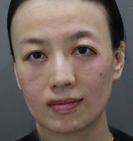 去眼袋手术