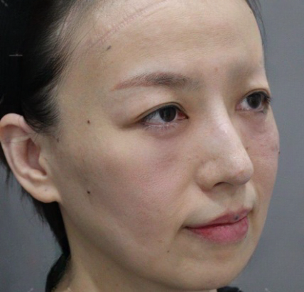 去眼袋手术