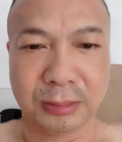 去眼袋手术