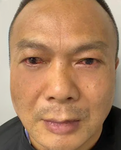 去眼袋手术