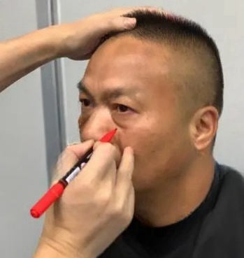 去眼袋手术
