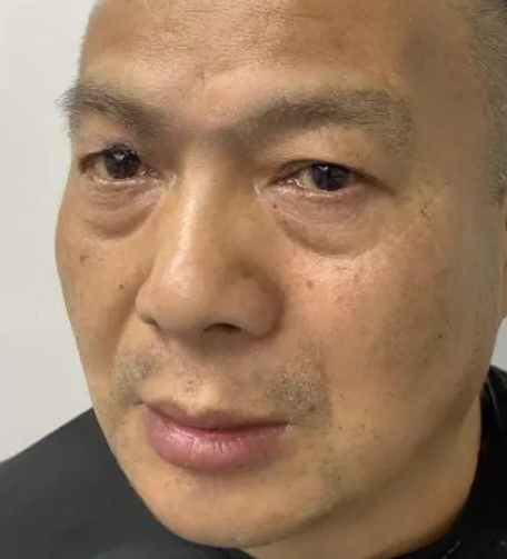 去眼袋手术