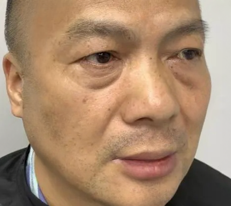 去眼袋手术