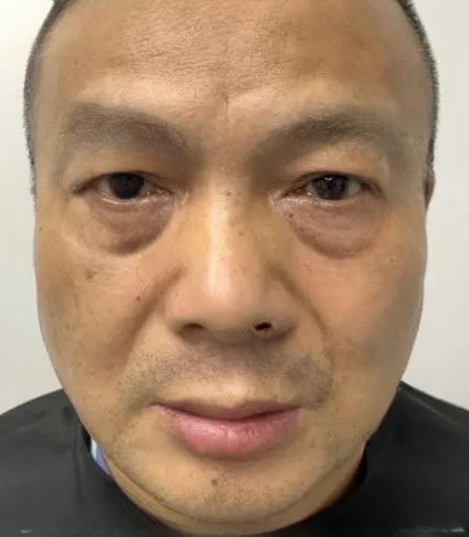 去眼袋手术