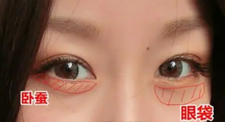 去眼袋手术