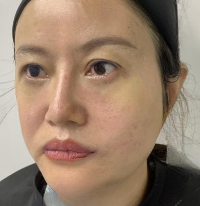 去眼袋手术