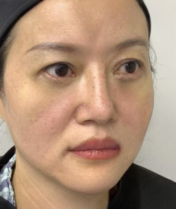 去眼袋手术
