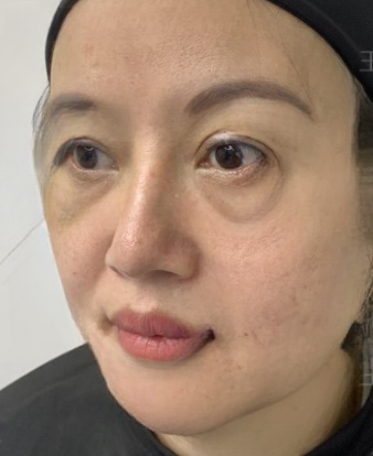 去眼袋手术