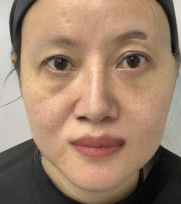 去眼袋手术