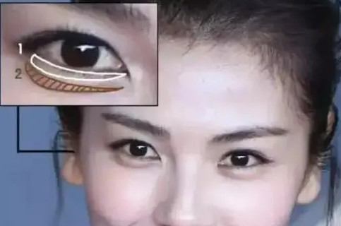 去眼袋手术