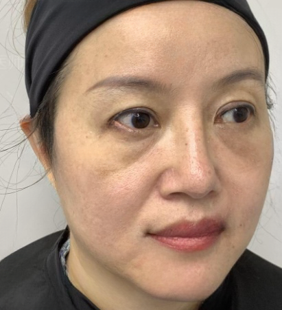 去眼袋手术