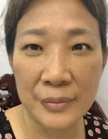 去眼袋手术