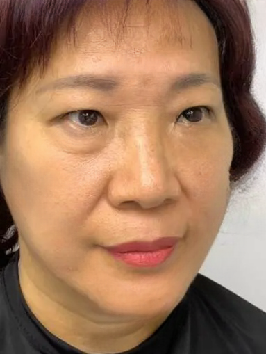 去眼袋手术