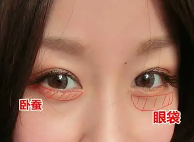 去眼袋手术