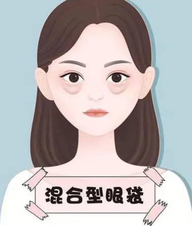 去眼袋手术