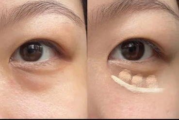 去眼袋手术