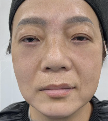 去眼袋手术