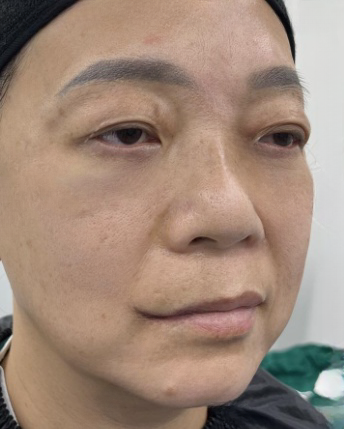去眼袋手术