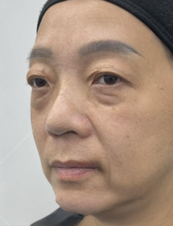 去眼袋手术