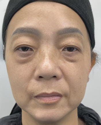 去眼袋手术