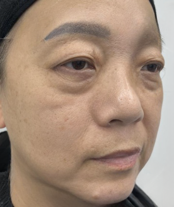 去眼袋手术