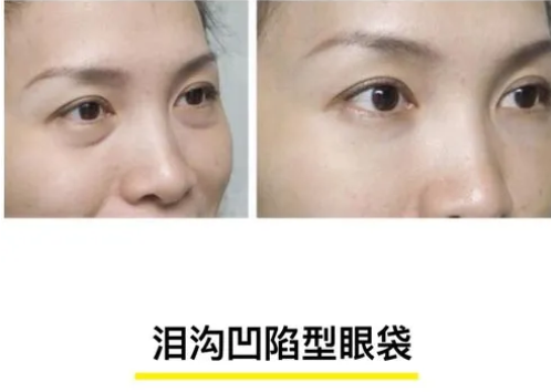 去眼袋手术
