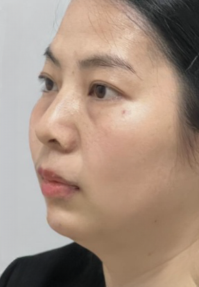 去眼袋手术