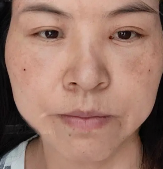 去眼袋手术