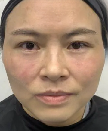去眼袋手术