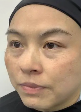 去眼袋手术