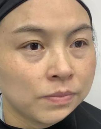 去眼袋手术